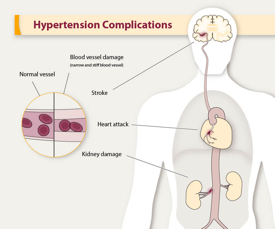 How normal is hypertension?